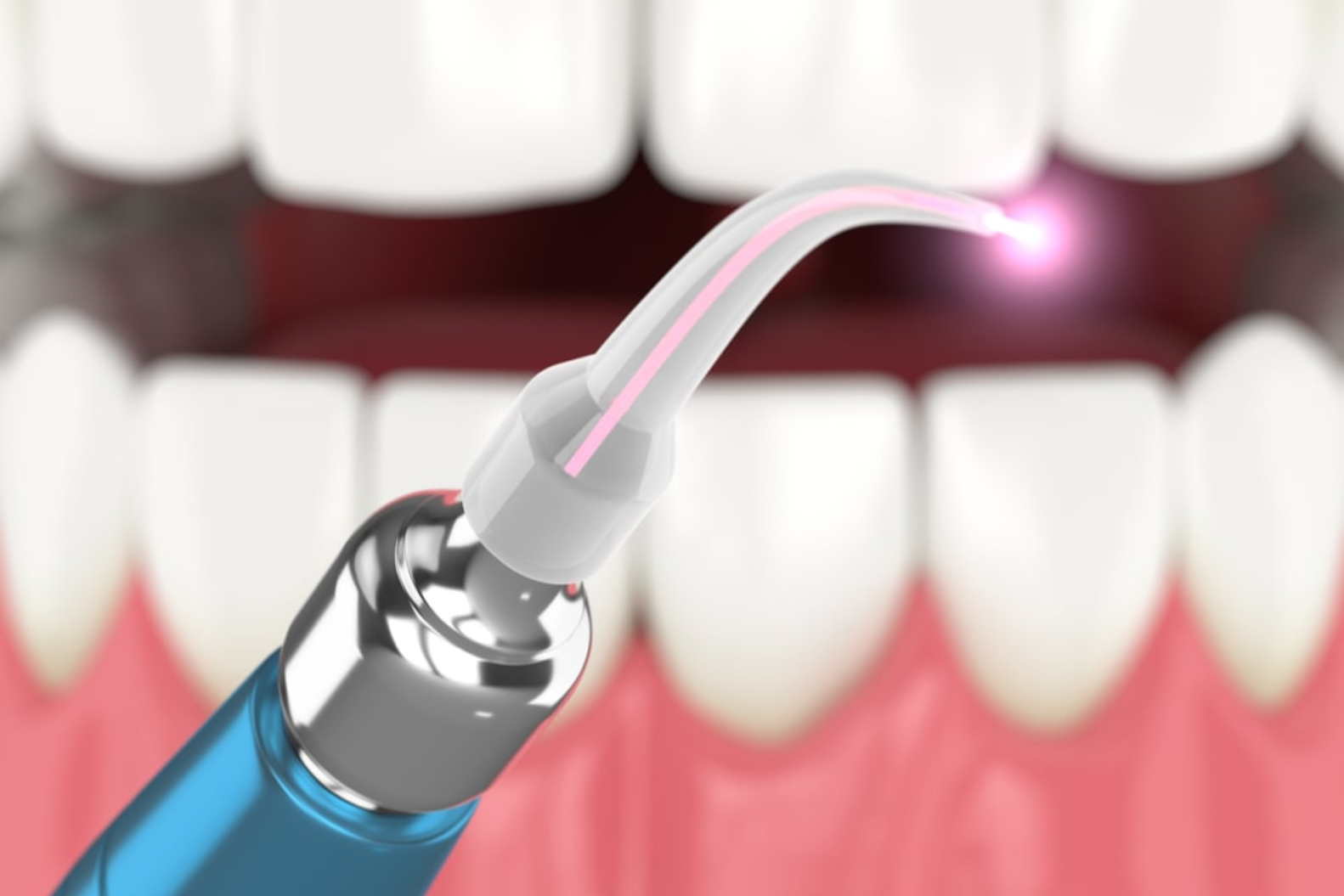 Featured image for “Laser Dentistry: The Future of Comfortable Care”