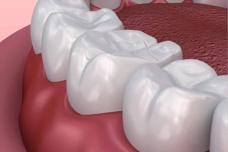 Dental Sealants