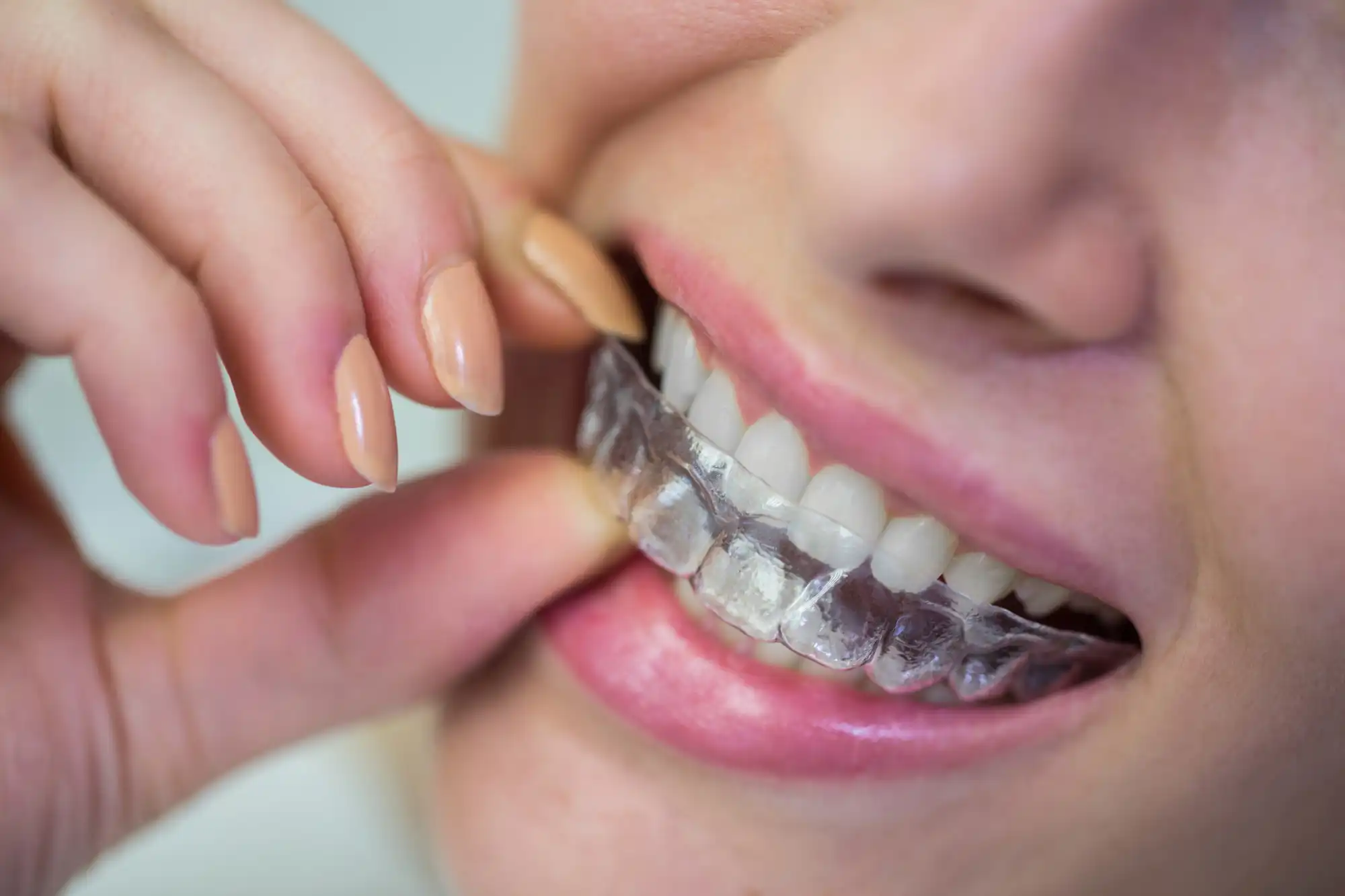 Timberridge_Invisalign