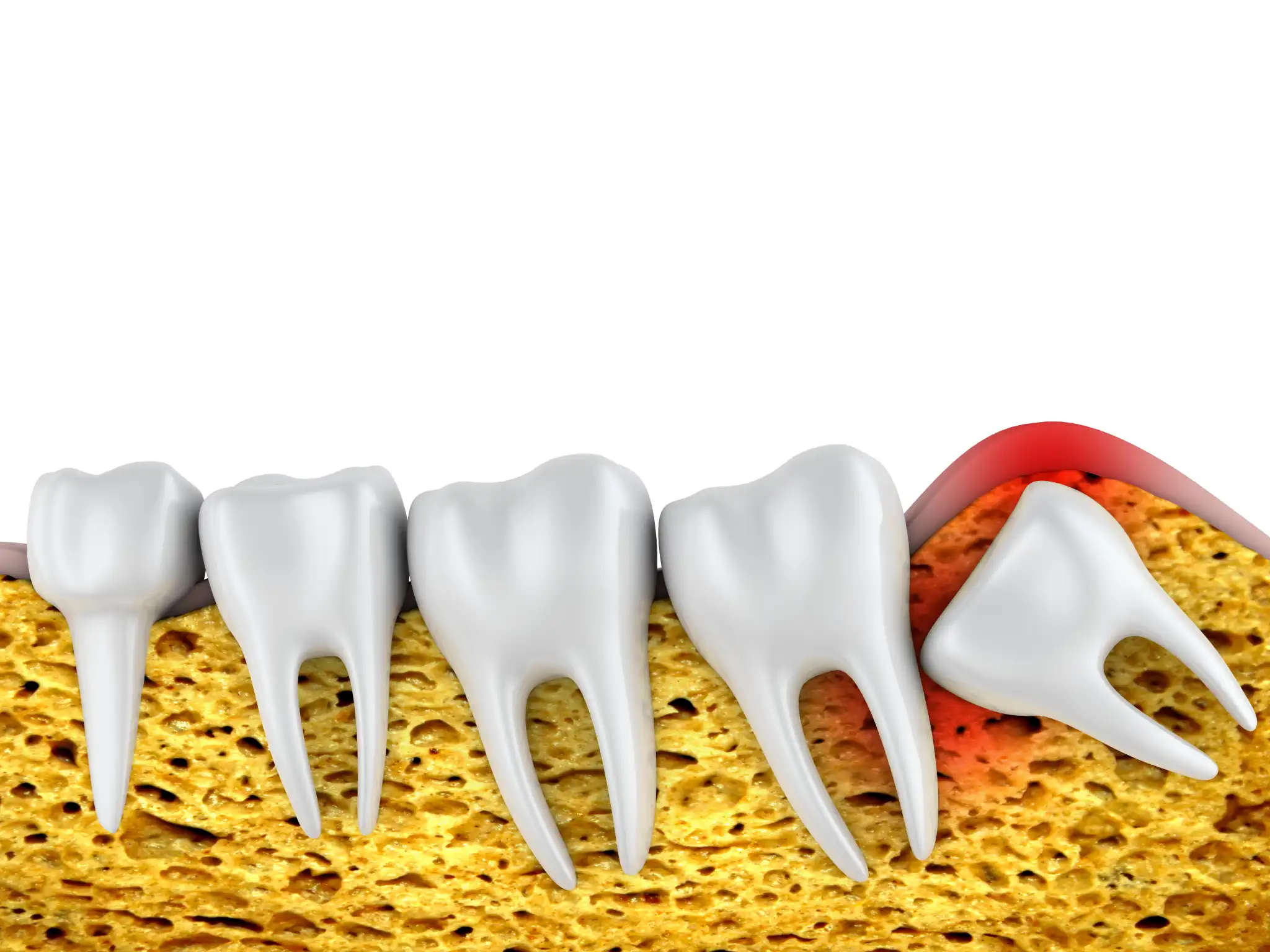 Timberridge_Wisdom_Teeth_Extractions