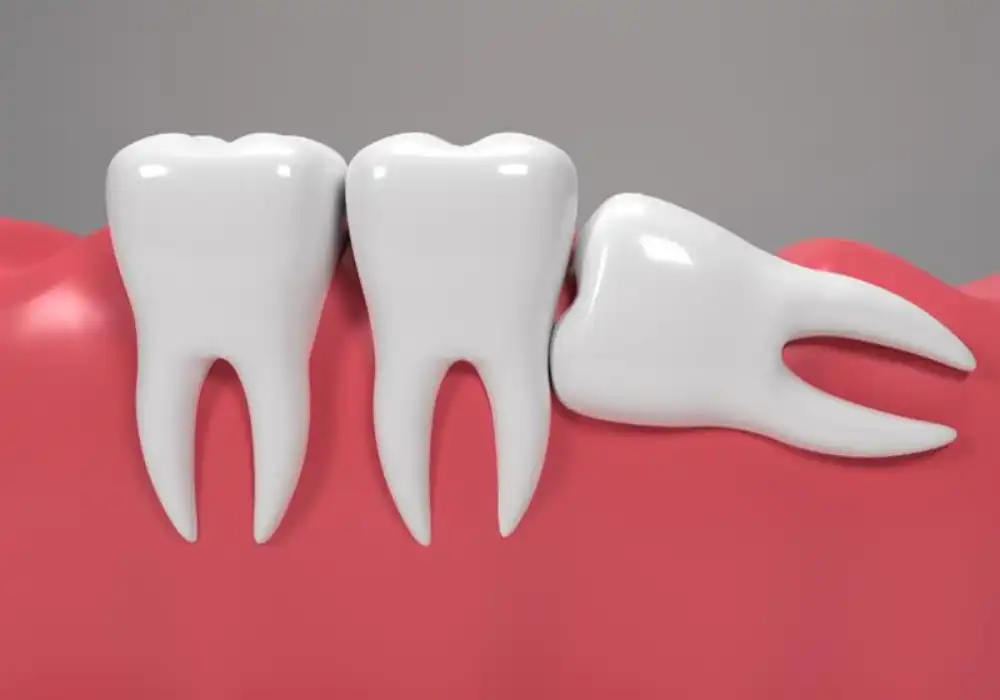 wisdom-tooth__1