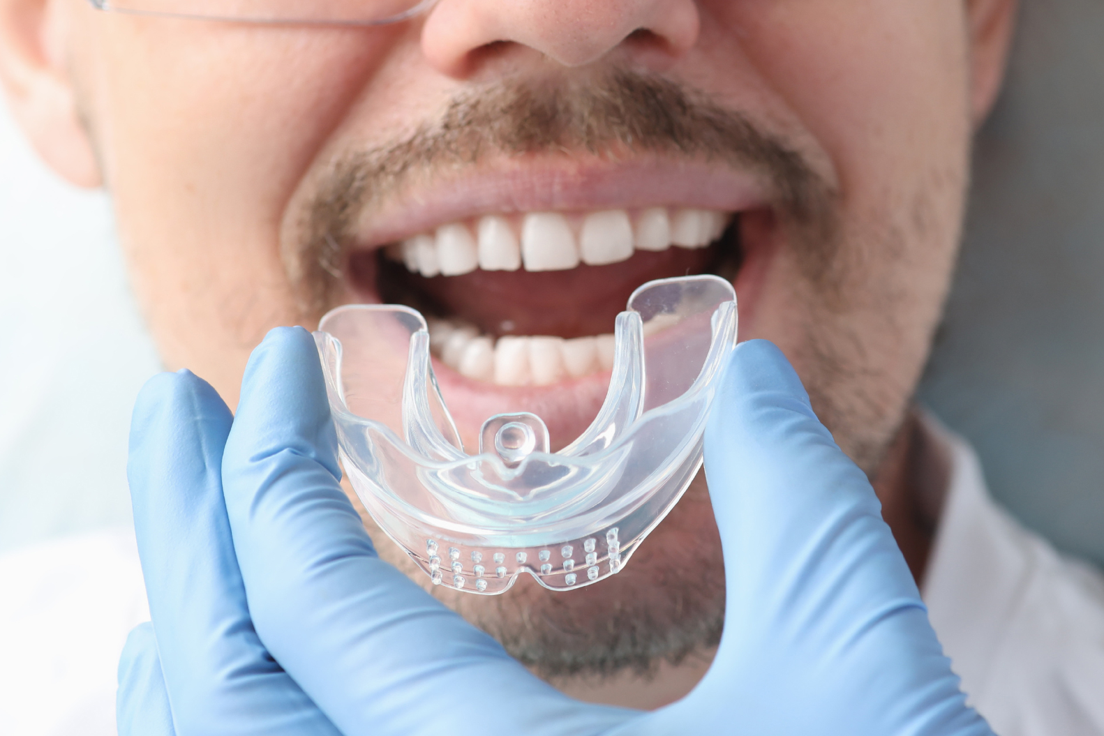 Custom-Fit Mouthguards