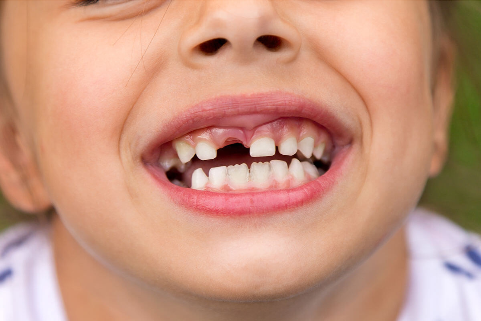 Knocked-Out Tooth